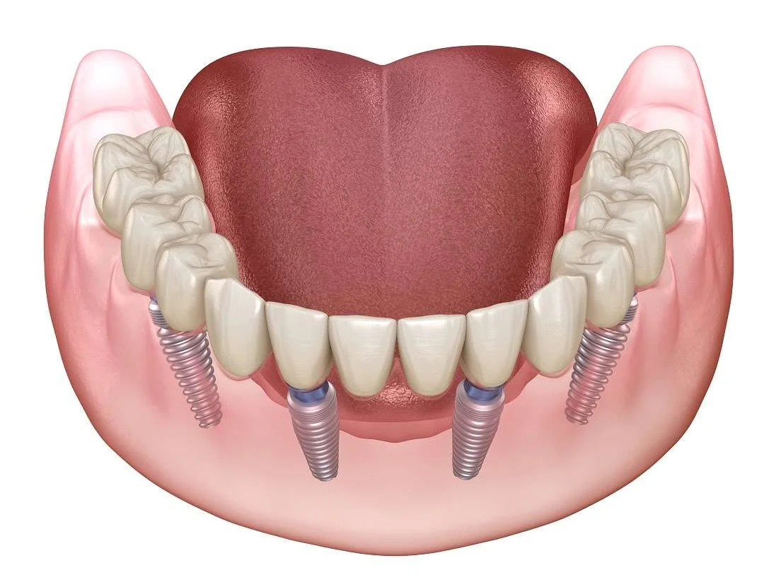 Dental Implants