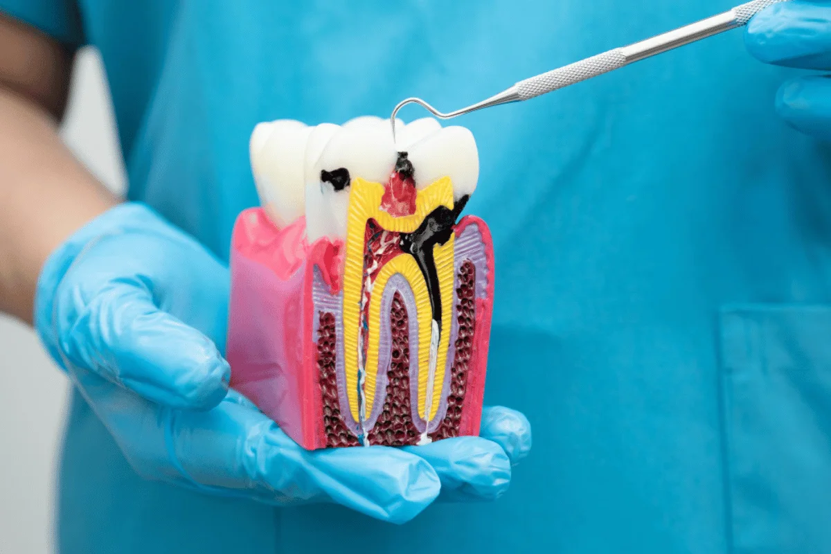 Painless Root Canal